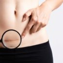 Comment masser la cicatrice d’une abdominoplastie ?