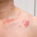 Le zona peut-il cacher un cancer : comment le diagnostiquer efficacement