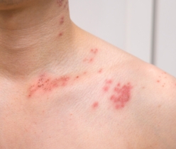 close up of man with shingles disease on skin